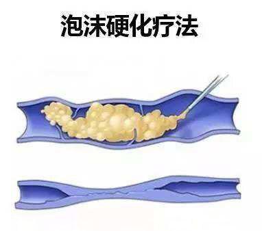 硬化剂疗法