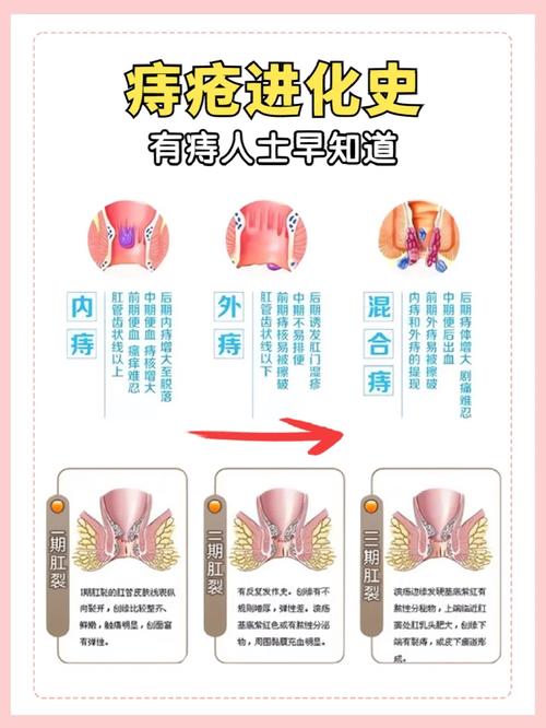 隔痔疮