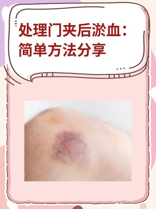 淤血处理