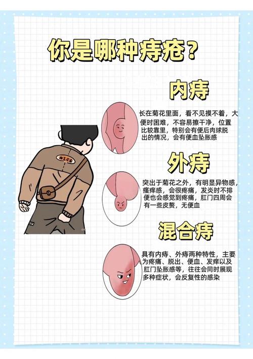 如何准确判断不同类型的痔疮？