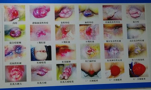 结缔组织性痔疮
