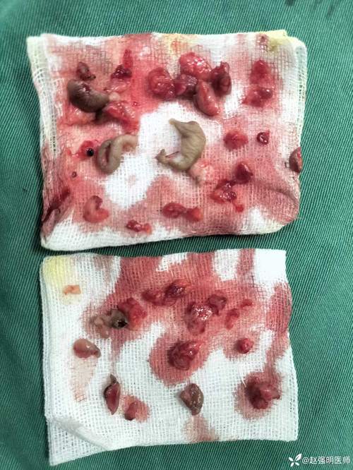 痔疮破损