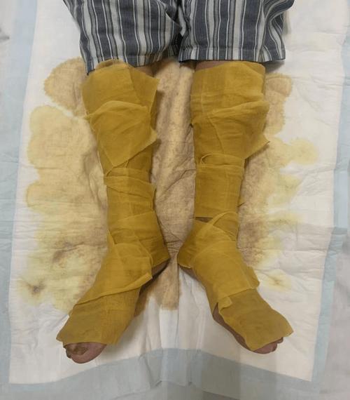  湿敷治疗
