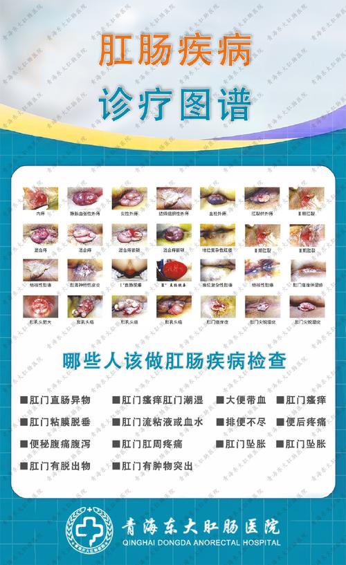 痔疮发生机制