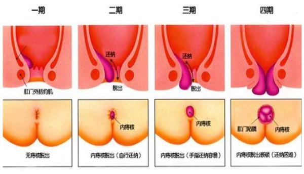 三度痔疮