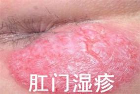 痔疮湿疹