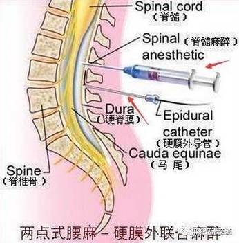 硬膜外麻醉