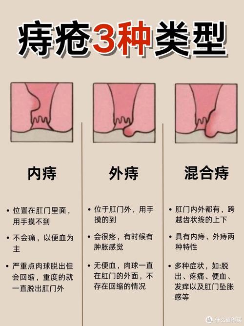 妇科痔疮