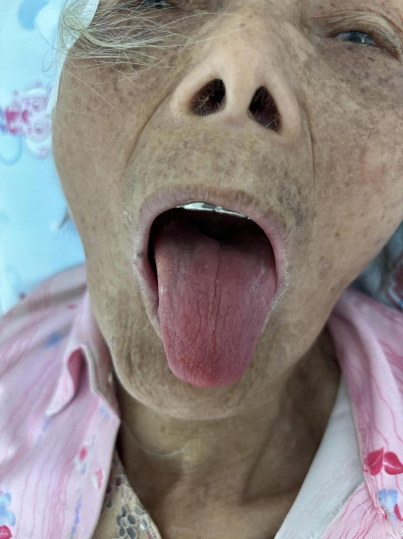 舌质红