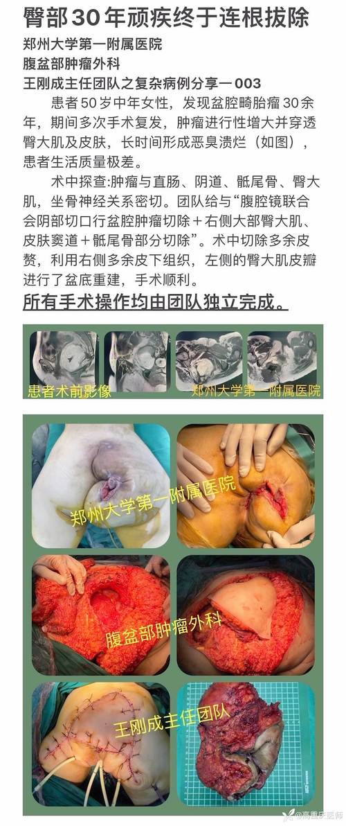 痔疮恢复