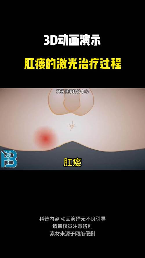 肛瘘治疗