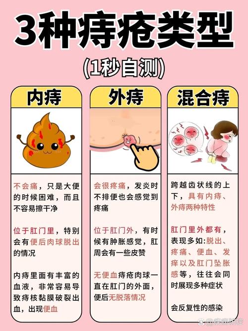 孕妇外痔疮
