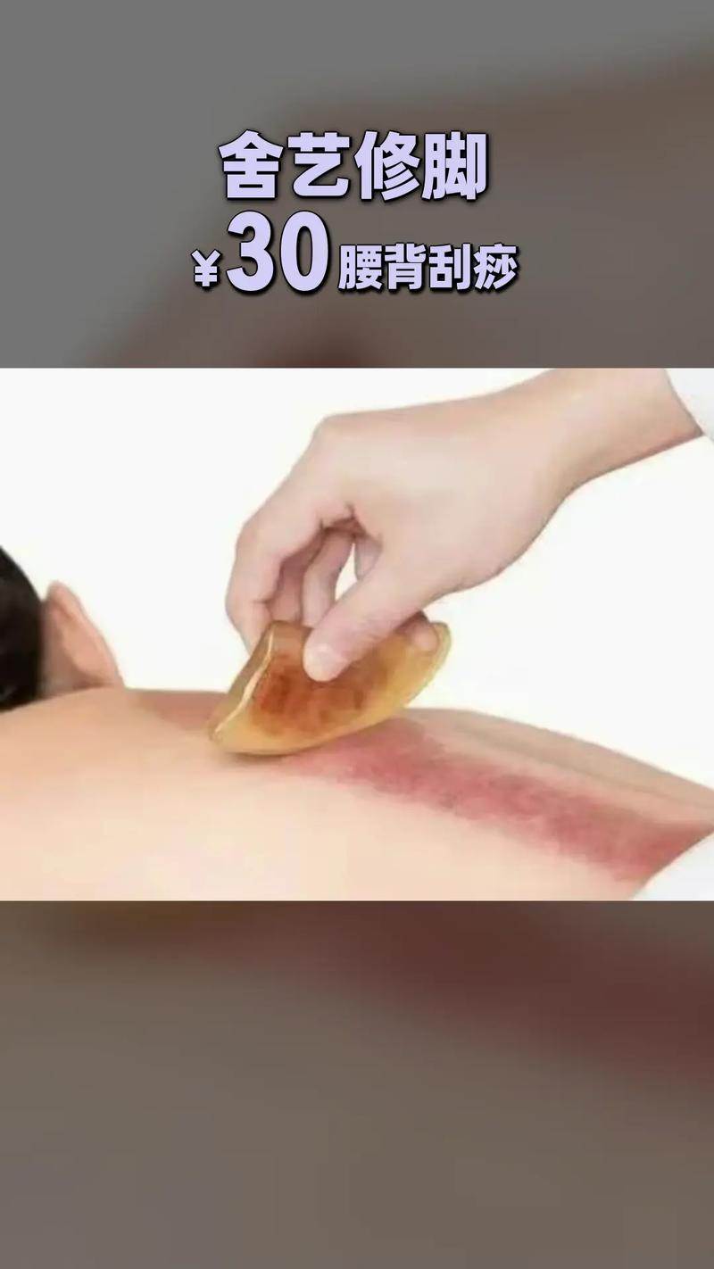 刮痧治疗