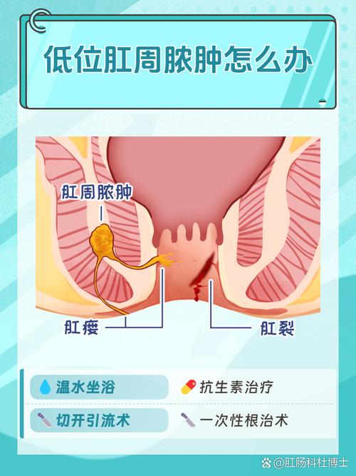 屁眼治疗方法