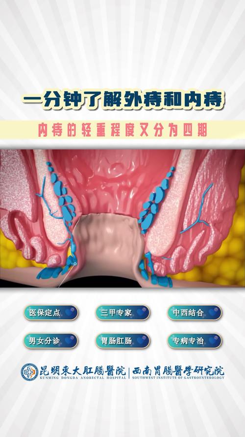 症状特征标志
描述: 本文详细介绍了内痔、外痔、混合痔的常见症状与特征标志，并配有相关图片。同时分析了症状产生原因及给出日常注意事项，助读者了解痔疮，早发现早治疗，远离困扰 。