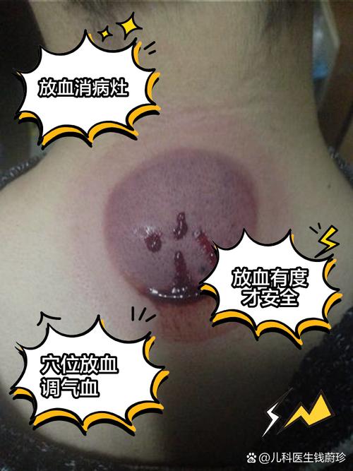 后腰放血