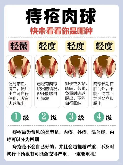 痔疮内硬球