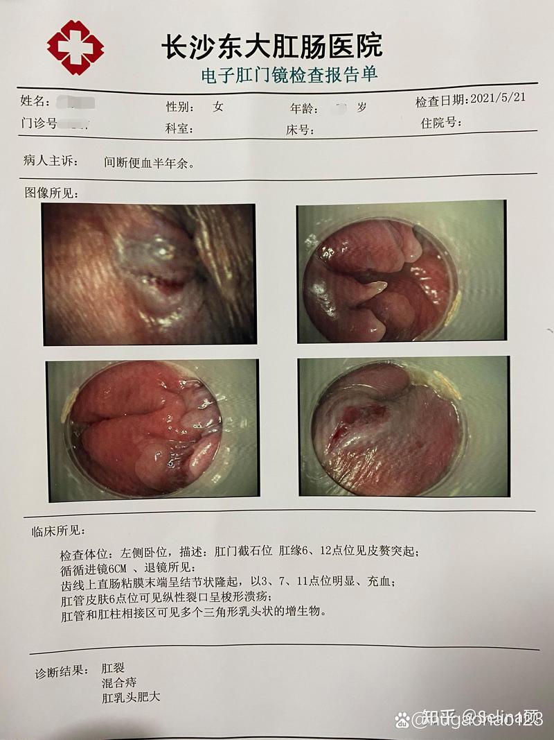 无痛割痔疮