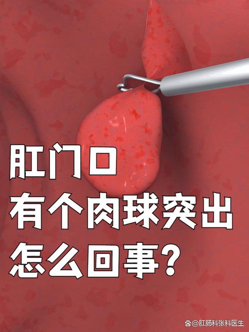 肛内硬块