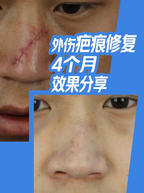 疤痕平复