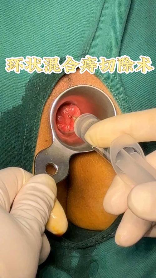 痔疮切除技术